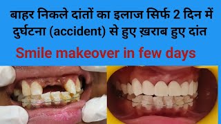 अजमेर राजस्थान  Ajmer बाहर निकले दांतों का इलाज सिर्फ 2 दिन में Smile makeover front teeth [upl. by Meuse]