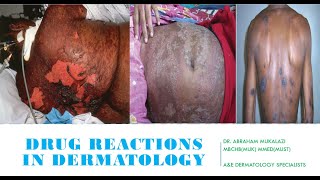 DRUG REACTIONS IN DERMATOLOGY BY DR ABRAHAM TEN SJS DRUG RASH dermatology lecture [upl. by Dewey716]