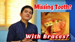 MISSING TOOTH WITH BRACES [upl. by Hsirahc]