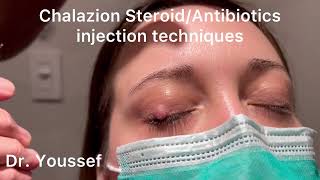 Chalazion Easiest and simplest Treatment with Steroid and Antibiotic Injections [upl. by Phelgon984]