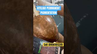 VITILIGO PERMANENT PIGMENTATION  FACE VITILIGO PERMANENT TREATMENT  VITILIGO COVERING  vitiligo [upl. by Maia127]