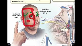 Millard Gubler syndrome  Ventral pontine syndrome  made super easy [upl. by Ahsinam]