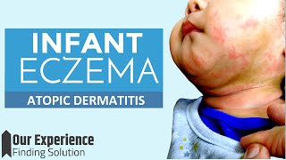 How to treat Infant Atopic Dermatitis Eczema  We found the Best Treatment for our Baby [upl. by Marleen]