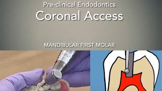 Coronal Access Mandibular First Molar [upl. by Aliakim]