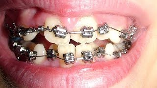 Ortodoncia con Brackets  Tratamiento Completo con Frenillos [upl. by Lemej]