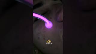 Face Acne Facial acne facial pimple [upl. by Belloir402]