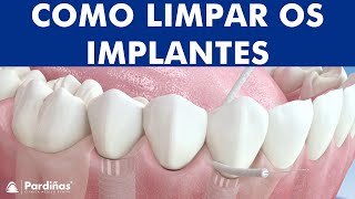 Fio dental e Irrigador  Limpeza de implantes dentários © [upl. by Dupuis]