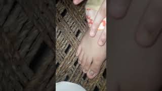 Trichophyton rubrum fungus nailinfection dermatology medical dermatology diagnosis foot [upl. by Nairoc714]