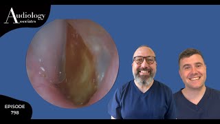 EPIC EAR WAX PEEL FROM EARDRUM  EP 798 [upl. by Otnicaj]