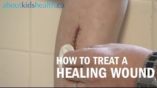 How to care for a healing wound  AboutKidsHealth at The Hospital for Sick Children [upl. by Eniawtna]