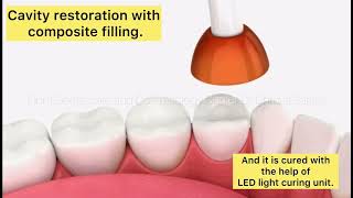 ✨Class l cavity restorationwith composite filling✨ drdhruvaodccshorts9385 dentalcare [upl. by Airamana]