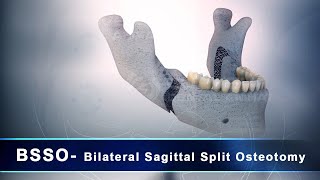 BSSOBilateral Sagittal Splitting Osteotomy  3D Dental Animation [upl. by Garland417]