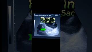 Pelvic Inflammatory Disease  PID  CuldeSac Fluid  Fluid in POD Pouch of Douglas in Ultrasound [upl. by Riffle]