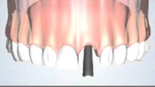 Dental implant video placement animation [upl. by Nolyd]