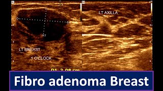 Fibroadenoma Breast Breast Lump  Brest ultrasonogram [upl. by Chelsy273]