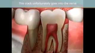 Cracked Cusp Syndrome [upl. by Corell]