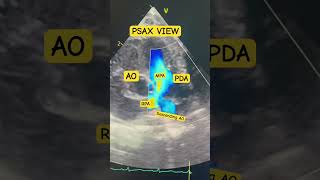 PDA Patent Ductus Arteriosus Pediatric Echo ♥️ [upl. by Naima]