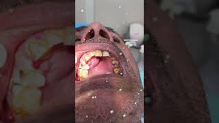 Dental abscess  extraction [upl. by Hildie]