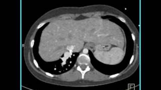 Total anomalous pulmonary venous return [upl. by Nuncia]