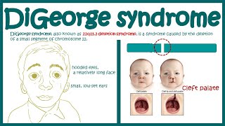 DiGeorge syndrome  22q11 2 deletion syndrome  Immunodeficiency [upl. by Macomber197]