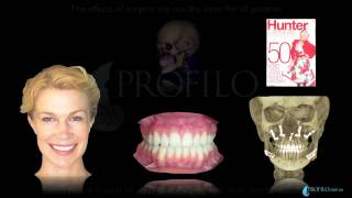 Bimaxillary Orthognathic Facial Cosmetic Plastic Jaw Surgery [upl. by Itida]