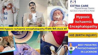 Hypoxic Ischaemic Encephalopathy  HIE in Babies Birth Injury  Pediatric Physiotherapy in Lucknow [upl. by Sharp123]