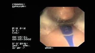 Epiglottic Blockage in Competitor Laryngeal Mask Airway [upl. by Corrina]