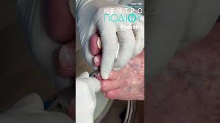 Nails Treatment callus κεντροποδιου kentropodiou podiatry podiatria podologia podiatrist [upl. by Artenra]