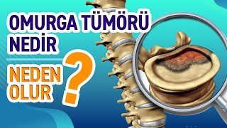 Omurga Tümörü Nedir Belirtileri ve Tedavisi  Profesör Doktor Gökhan Demirkıran [upl. by Drugi176]