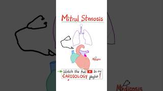 Mitral Stenosis MS  Valvular Heart Diseases VHD Part 2…anatomy mbbs cardio cardiology [upl. by Pablo]