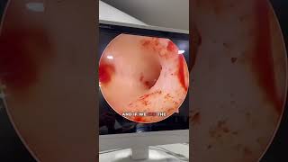 Examining a Small Uterus and Endometritis Using Hysteroscopy [upl. by Tuorah]