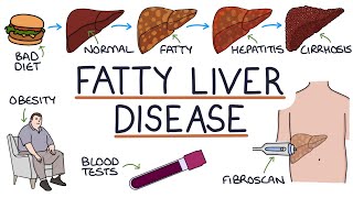 Understanding NonAlcoholic Fatty Liver Disease [upl. by Eliot]