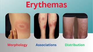 Erythemas Uncovered Insights into Morphology Associations and Distribution [upl. by Kernan576]