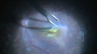 Epi Retinal gliosis Removal [upl. by Asselam]