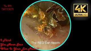 Want CLEAR Ears Watch This Deep Ear Wax Cleaning Now [upl. by Htiduy834]