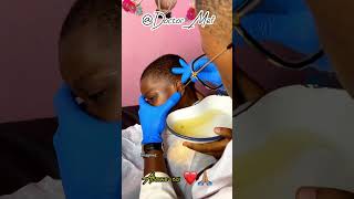 Un énorme bouchon de cérumen bouchait son oreille 👂🏽  Extraction 😱😍 [upl. by Kazimir]