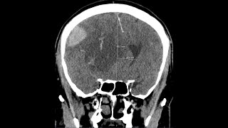 Brain herniation  subphalcine  due to intracranial haemorrhage CT findings [upl. by Aisaim]