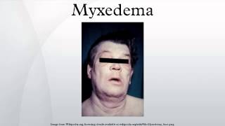 Myxedema [upl. by Aranahs]