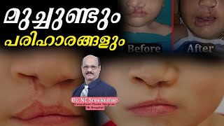 മുച്ചുണ്ടും പരിഹാരങ്ങളും  Cleft Lip  Cleft Lip Treatment  SK Hospital [upl. by Llenrag]