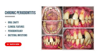 Chronic periodontitis Etiology Clinical features periodontal health [upl. by Ocir412]