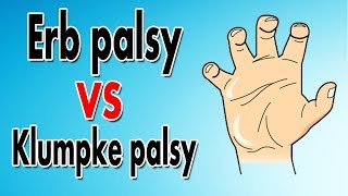 Erbs Palsy vs Klumpkes Palsy [upl. by Tandi]