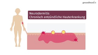 Was ist Neurodermitis und wie kann man sie behandeln [upl. by Fadiman]