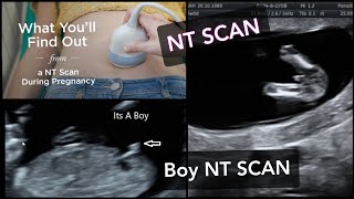 NT SCAN  How to Find Babys Gender In NT SCAN  NT scan report pregnancy ntscanreport ntscan [upl. by Lili]