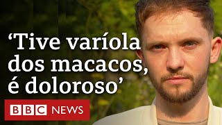 Jovem conta como é ter varíola dos macacos [upl. by Britt]