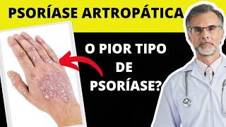 O QUE É PSORÍASE ARTROPÁTICA  SAIBA [upl. by Wilscam]