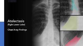 Atelectasis Right Lower Lobe Explanation of Chest Xray Findings [upl. by Aseretairam798]