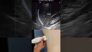 Lung Zone Right 4 with Handheld Ultrasound Exo Iris® [upl. by Kcirderf]