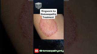 दाद का होमियोपैथिक ईलाज। Ringworm And Its Homoeopathic Treatment ringworm homeopathy trending [upl. by Ailati]