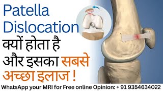 Patella Dislocation क्यों होता है और इसका सबसे अच्छा इलाज  Advanced MPFL Reconstruction Surgery [upl. by Lucinda]