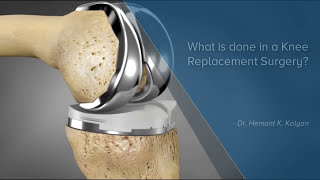 What is Done In A Knee Replacement Surgery Best Orthopedic Surgeon In Bangalore Manipal hospitals [upl. by Fayola]